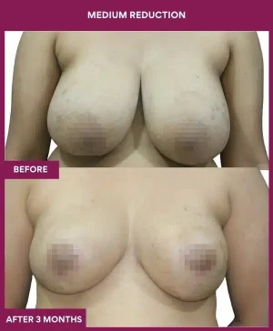 Medium Reduction Surgery in Mumbai, India