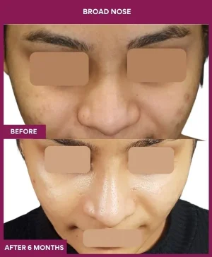 5 BROAD NOSE (3)_14_