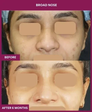 5 BROAD NOSE (4)_14_