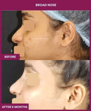 5 BROAD NOSE (5)_14_