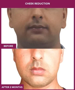 5 Cheek Reduction_10_