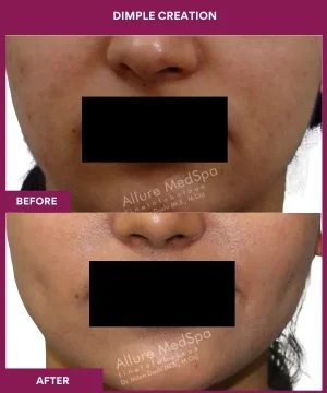 Dimple Creation Surgery in Mumbai