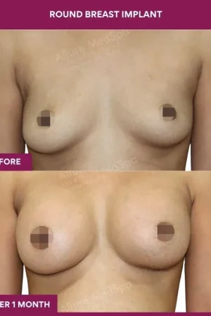 5 Round breast implant (4)_14_