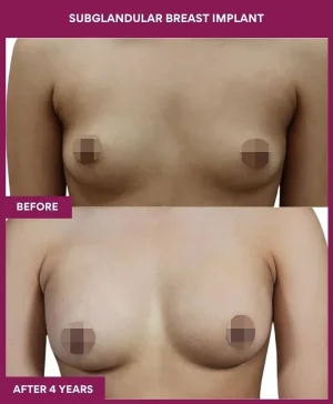 5 SUBGLANDULAR BREAST IMPLANT_15_ (1)