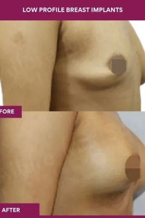 5 low Profile Breast Implants (2)_13