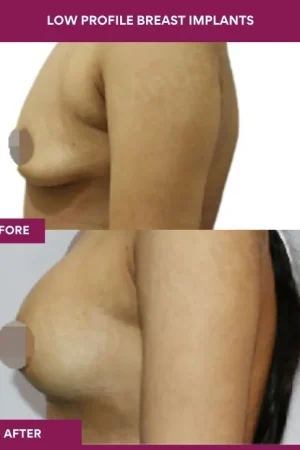 5 low Profile Breast Implants (3)_14