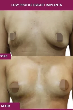 5 low Profile Breast Implants_15