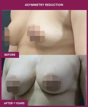 6 Asymmetry Reduction (3)