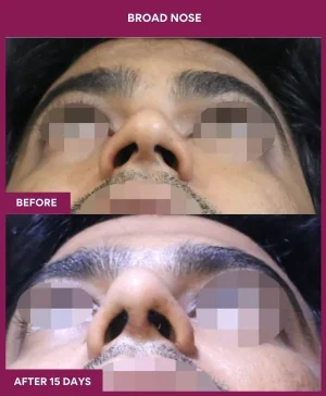 6 BROAD NOSE_18_ (3)