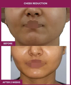 6 Cheek Reduction_24_
