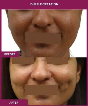 Dimple Creation treatment in mumbai, India