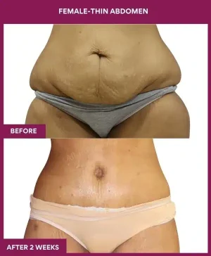 6 FEMALE-THIN ABDOMEN_18_ (1)