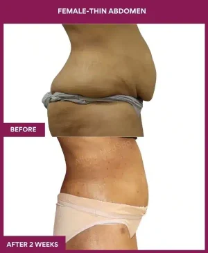 6 FEMALE-THIN ABDOMEN_18_ (3)