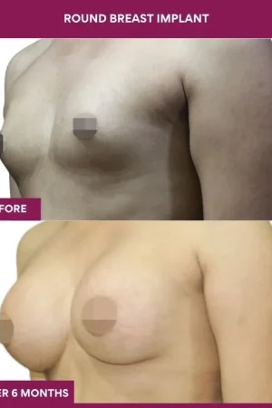 6 Round breast implant (2)_16_