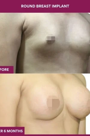 6 Round breast implant (3)_16_