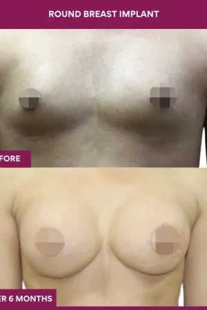 6 Round breast implant (4)_16_