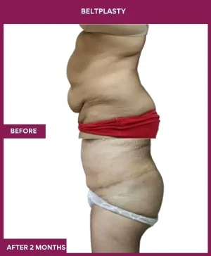 7 BELTPLASTY_21_ (3)