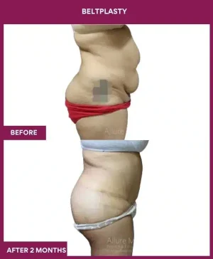 7 BELTPLASTY_21_ (5)