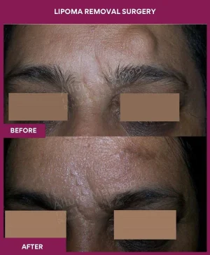 7 Lipoma Removal Surgery