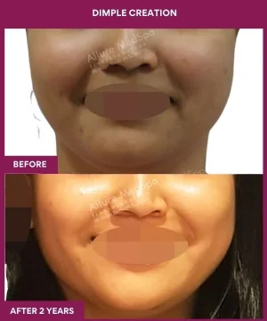 Female Dimpleplasty in Mumbai, India