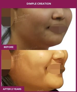 Female Dimpleplasty in Mumbai, India