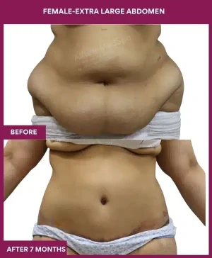 9 FEMALE-EXTRA LARGE ABDOMEN_ (1)