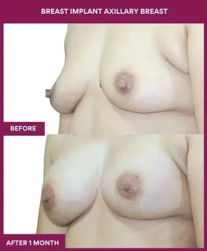 BREAST IMPLANT AXILLARY BREAST in Mumbai, India