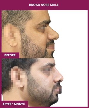 BROAD NOSE MALE Surgery In Mumbai, India