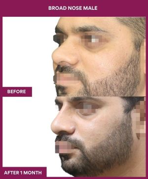BROAD NOSE MALE Surgery In Mumbai, India