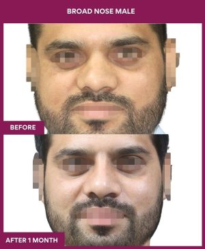 BROAD NOSE MALE Surgery In Mumbai, India