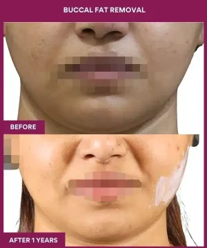 BUCCAL FAT REMOVAL in Mumbai, India