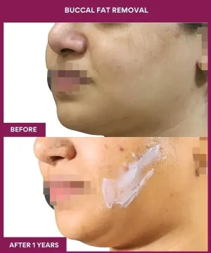 BUCCAL FAT REMOVAL in Mumbai, India