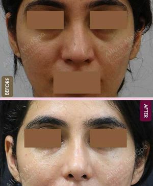 Complete-Rhinoplasty-Surgery-Before-and-After-Gallery-in-Mumbai-India