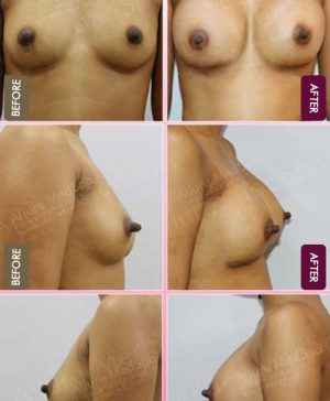 Submuscular-Breast-Implant-Before-After-photos-mumbai-india