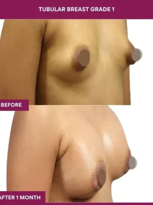 TUBULAR BREAST GRADE 1 (2)_1