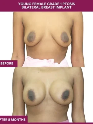 YOUNG FEMALE GRADE 1 PTOSIS BILATERAL BREAST IMPLANT in Mumbai, India