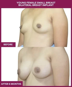 YOUNG FEMALE SMALL BREAST BILATERAL BREAST IMPLANT in Mumbai, India