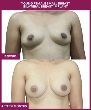 YOUNG FEMALE SMALL BREAST BILATERAL BREAST IMPLANT in Mumbai, India